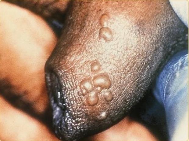 Example of herpes skin rash
